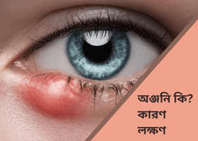 anjoni-stye-karon-lokkhan-chikitsha-homeopathy