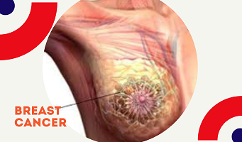 ব্রেস্ট ক্যান্সার ও প্রতিরোধ