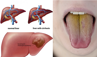 আমাদের জিহ্বা আমাদের লিভার সম্পর্কে কী বলে