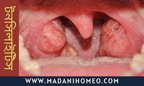 টনসিলাইটিস