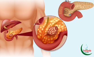 প্যানক্রিয়াটাইটিস