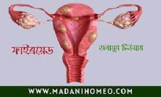 ফাইব্রয়েড