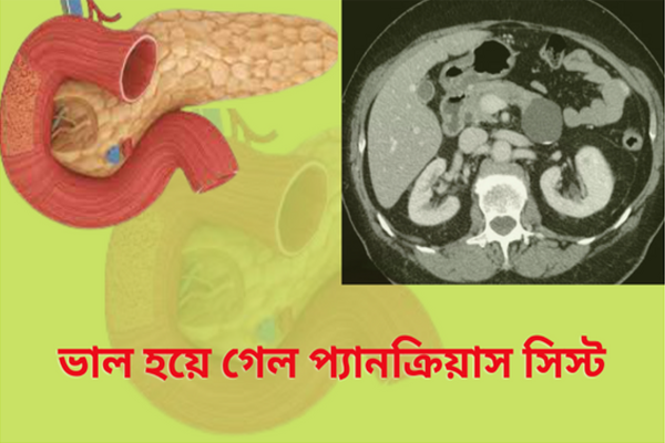 ভাল হয়ে গেল প্যানক্রিয়াস সিস্ট