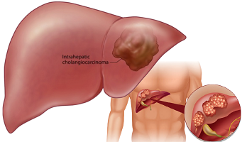 ভাল হয়ে গেল  লিভার ক্যান্সারসহ টিউমার