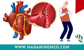 হার্ট অ্যাটাক