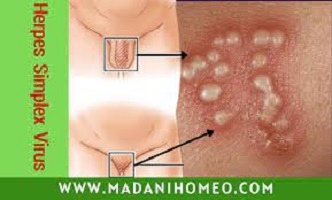 হার্পিস