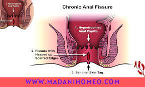 এনাল ফিসার