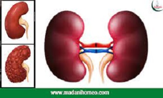 কিডনি ভাল রাখার উপায়