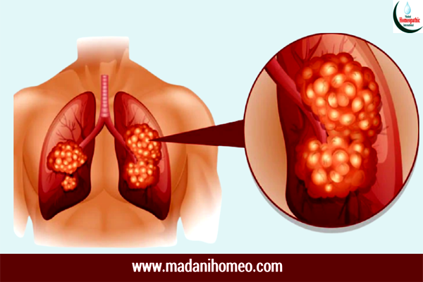 ফুসফুস রোগের কারণ