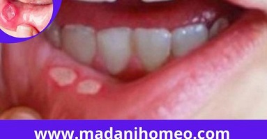 মুখের ঘা ও ঘরোয়া চিকিৎসা