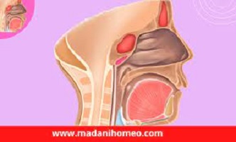 সাইনোসাইটিস ও প্রতিরোধ