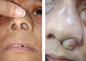 নাজাল পলিপ