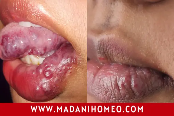 ভালো-হয়ে-গেলো-জন্মগত-হেমানজিওমা