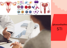 ট্রাইকোমোনিয়াসিস (1)