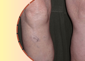 প্যাজেট'স ডিজিজ (Paget's Disease)Disease (1)