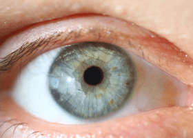 Cataracts symptoms, treatment, home remedies (1)