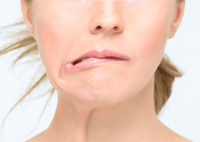 মুখ বাঁকা হয়ে গেলে কী করবেন লক্ষণ, কারণ ও করণীয় (1)