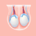 testicular-problem-varicocele-homeopathy-treatment-case-study (1)